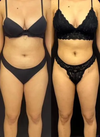 Comparação antes e depois do tronco de uma mulher