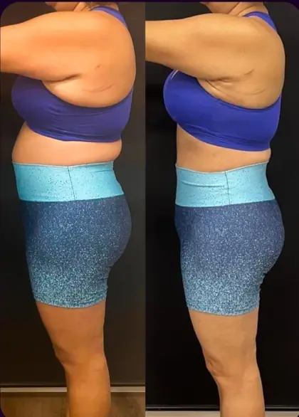 Comparação antes e depois de mulher em vista lateral