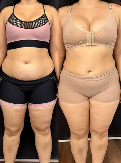Comparação antes e depois de mulher em vista frontal